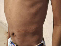 Help Vikas Recover from Thalassemia