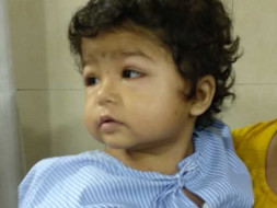 Help 2-year-Old Shraddha Fight Nephrotic Syndrome