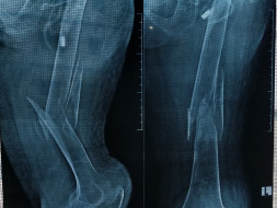 Help my grandmother for thighbone joint surgery