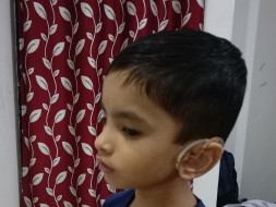 Help Shrijay Undergo Cochlear Implant Surgery