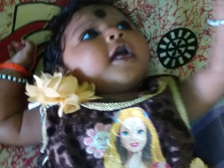 Baby suffering with "Microcephaly "