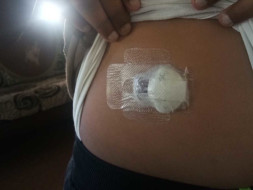 Help Shruthvidh Undergo Treatment For Type 1 Diabetes.