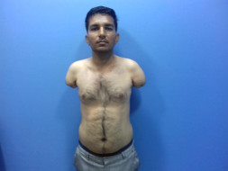 Help Prema Undergo Upper Limb Transplant Surgery