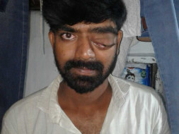 Help Muthyal Rao to Fight against Brain Tumor & Eye fitsula