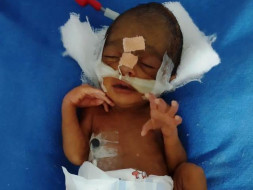 Help Baby Of Rachana Who Was Preterm (30 weeks)
