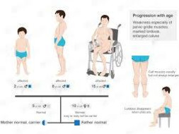 Help Muscular Dystrophy Patients Kindly Donate For The Cause