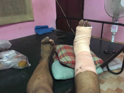 Help Me Complete My Leg Surgery