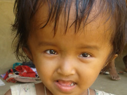 Help 4 Year Old Reshmi Fight Hydrocephalus