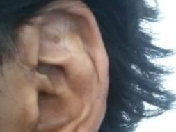 Help Mohd for Ear surgery
