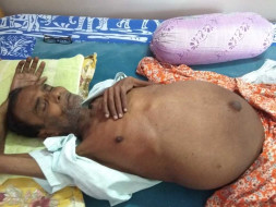 Help My Father Undergo A Liver Transplant