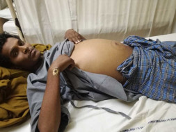 Help Ramesh Undergo Liver Transplant