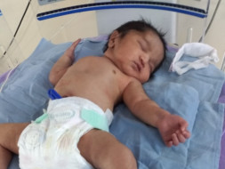 Help 2-Month-Baby Suffering From Bronchomalacia