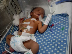 Help This Baby From Aspiration Syndrome