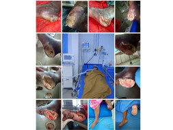 Help Jyothi Type-2 Diabetic with Infected leg removal & Blurred Vision