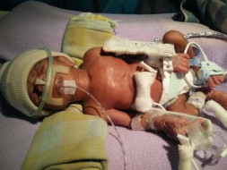 Help My 13 Day Old Baby In NICU