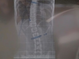 Help greeshma (spinal bend surgery)