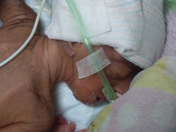 Help for my premature baby of low birth weight due to born at 28 weeks