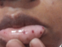 Help Me From MEGAKARYOCYTIC THROMBOCYTOPENIA SLE (Auto immune disease)