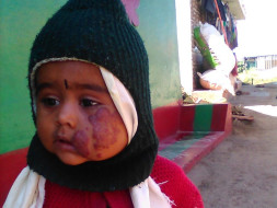 Help My Daughter Recover From Swelling In The Face