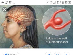 Help my mother recover from Brain Aneurysm