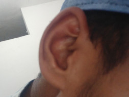 Help Me For My Ear Operation