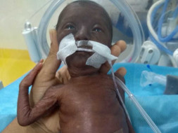 Help Premature Baby To Live