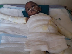Help 4-year-old Krishive Recover From 2nd Degree Burns