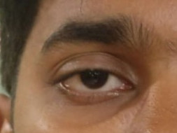 24 yr old Ashish needs help for his eye surgery