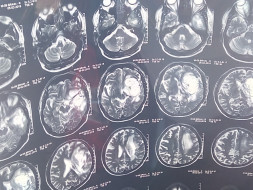 Help for Brain Surgery