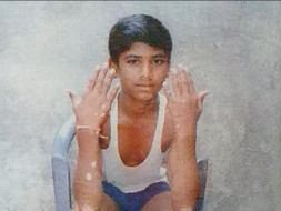 Please help Revannath to Fight Against skin diseases