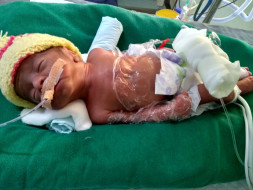 Help My Premature Baby Recover