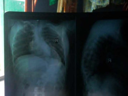 Help Tanuja fight scoliosis