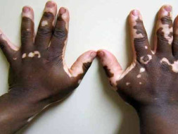 Help People Suffering From Vitiligo/Leucoderma