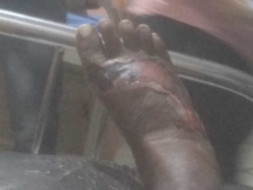 Help Myself Recover From Foot Infection And Surgery.