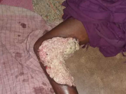 Help Shankar Fight Skin Cancer