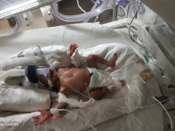Help twins of Naveen and Bhuvaneshwari survive