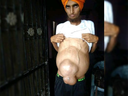 Pawandeep fighting with liver problem!