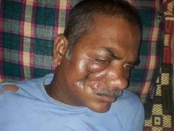 Help Kalusingh Fight Oral Cancer