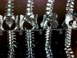 Help Subarna suffering from Spinal Cord Injury