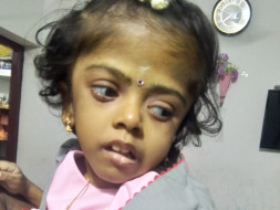 Help Daniska Recover From Hydrocephalus