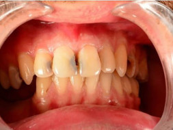 Help Me Raise Funds For My Tooth Surgery