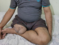 Help Nagendra Fight Disability
