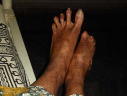 Help Me Recover From Systemic Sclerosis