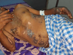 Help Rajanna Recover From Electrocution