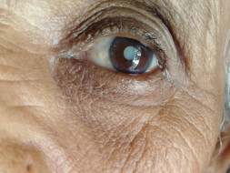 Help Me To Undergo An Eye Surgery
