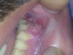 38 Years Old Gaurav Tiwari Needs Your Help Fight Oral Cancer