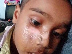 Help Baby Ayan for Plastic Surgery