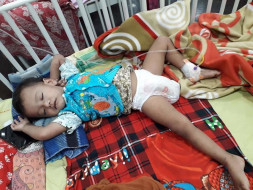 2 Years Old Piku Saha Needs Your Help To Fight Bone Marrow Aplasia