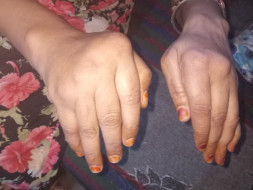 Help Me To Cure My Mother's Arthritis