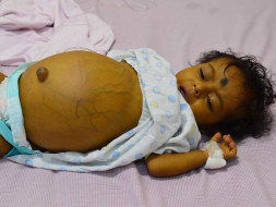 My 9 month old son needs a Liver Transplant as soon as possible